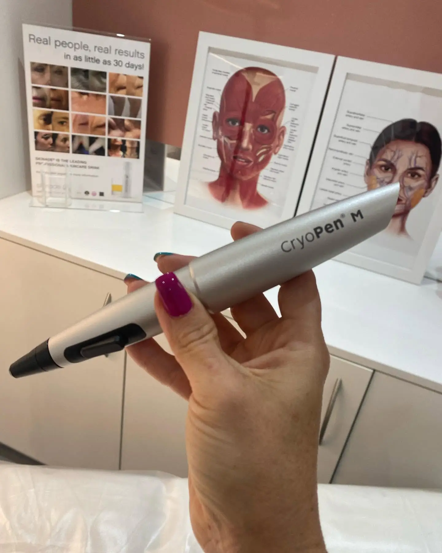 Close-up of the CryoPen device